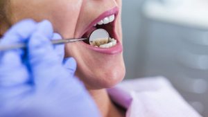 Wisdom Tooth - Reasons Why You Need To Have It Removed