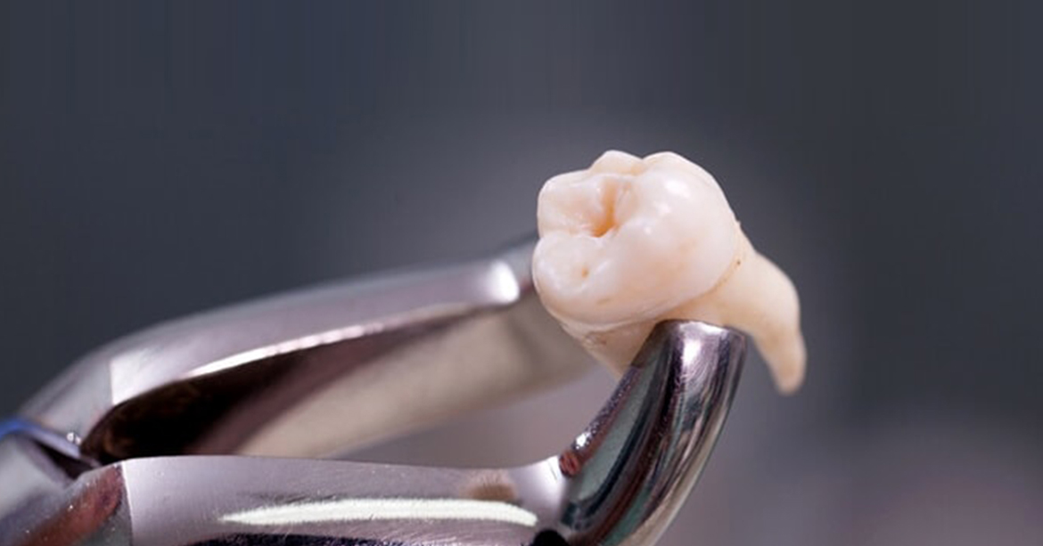What Needs To Be Kept In Mind While Going For The Wisdom Tooth Extraction In Singapore