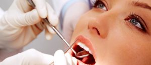 What are dental impressions for braces
