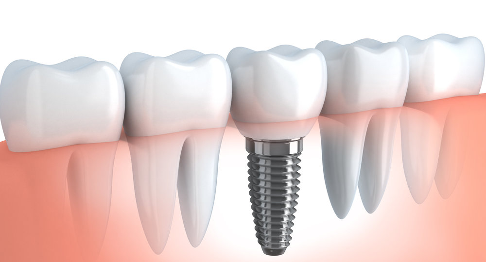 How Do You Prepare for a Tooth Implant